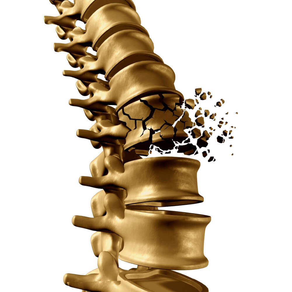 Spinal Compression Fracture