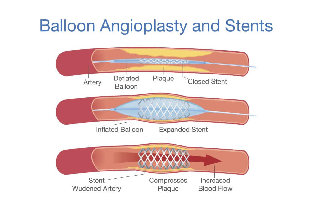 balloon angioplasty and stents