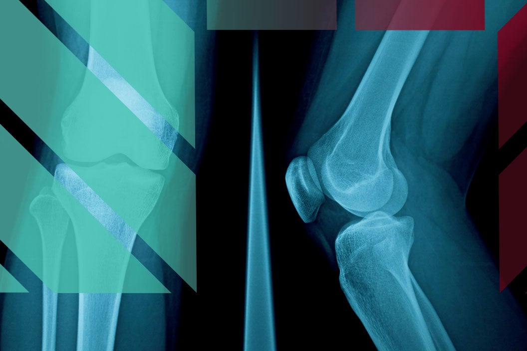 x-ray of a knee