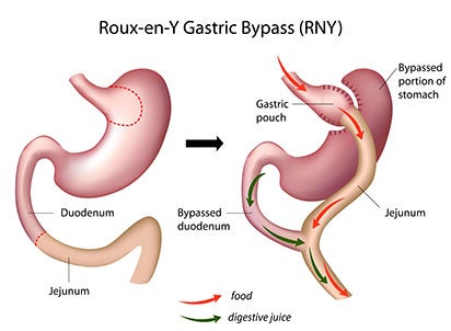 Gastric bypass surgery from Mount Carmel is a permanent solution during which our surgeons make the stomach smaller and allow food to bypass part of the small intestine.