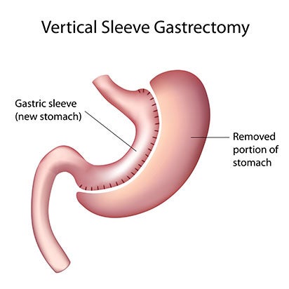 During a sleeve gastrectomy at Mount Carmel, approximately 80 percent of the stomach is removed, leaving it in the shape of a tube or 