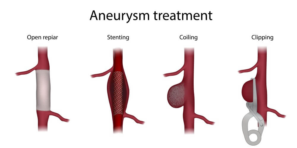 aneurysm treatment graphics